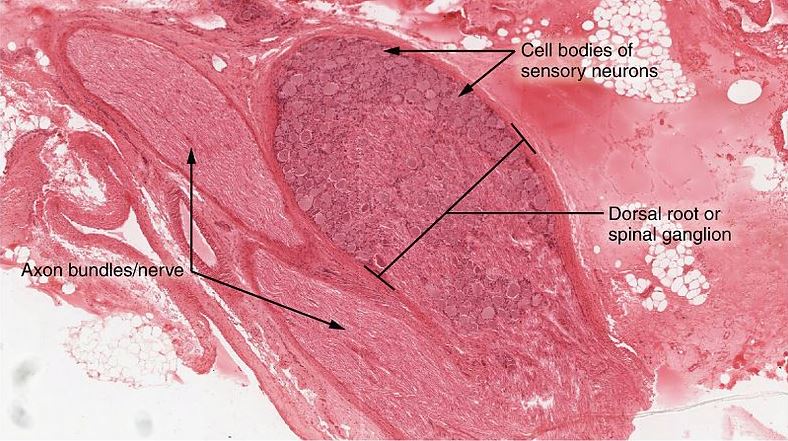 Inflammation of the Dorsal Root Ganglion